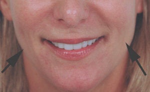 Restylane for cheek augmentation after 93358