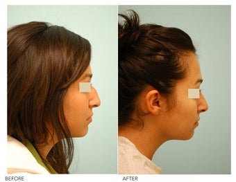 Revision/Corrective Rhinoplasty before 136574