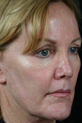Radiesse to the cheeks 308300