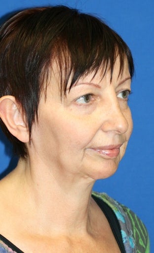 Facelift, Fat Transfer, Upper Bleph, Lower Eyelid Skin Pinch before 519865