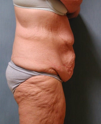 Lower Body Lift 410337