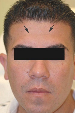 Botox treatment for forehead after 91060