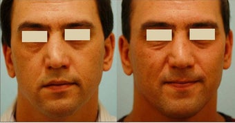 Revision/Corrective Rhinoplasty before 136561