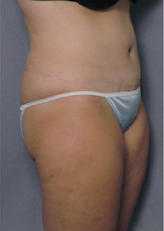 Tummy Tuck 428193