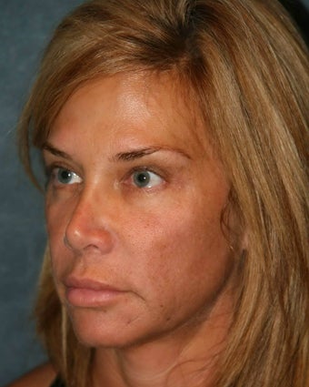 Ultherapy 499168