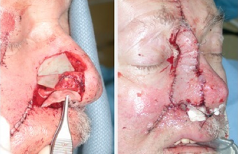 Facial Reconstruction after MOHS Surgery after 378710
