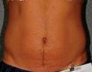 Liposonix after 582725