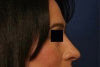 Rhinoplasty after 130765