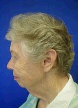 Chin Implants before 357644