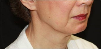 Ultherapy 421635