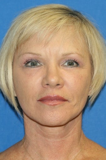 Facelift, Fat Transfer, and Skin Pinch after 398946