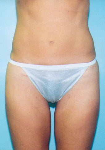 Mini-Tummy Tuck with Liposuction after 265962