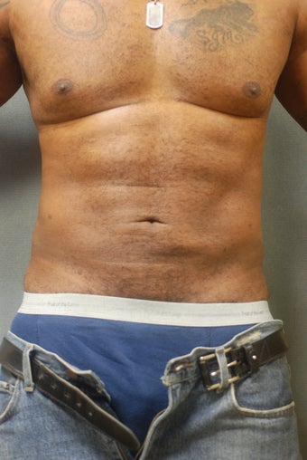 SmartLipo Breasts & Abs after 356667