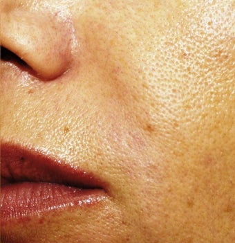 Sculptra after 184973