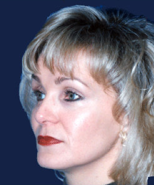 rhinoplasty after 476636