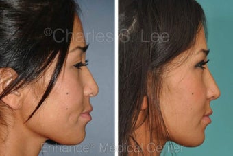 Nose before 431402