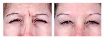 Botox for expression lines before 6326