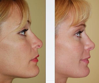 Revision Rhinoplasty before 346255