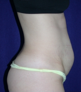 Tummy Tuck (abdominoplasty) 208463