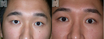 Asian Blepharoplasty before 314254