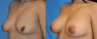 Flash Recovery Breast Augmentation TM before 253908