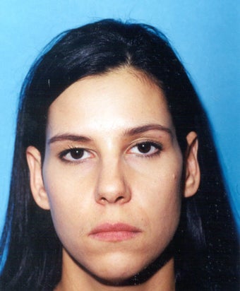 Endoscopic Browlift - Facial Plastic Surgery before 224861