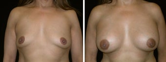 47 year old female, breast augmentation, San Francisco, California before 628329