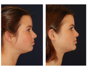 Chin Lipo 346991