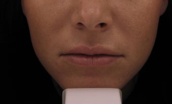 Belotero in the Lips after 581291