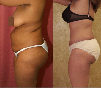 tummy tuck 304680