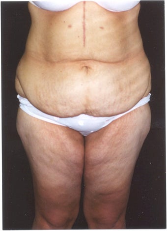 Body Lift and Inner Thigh Lift before 379793