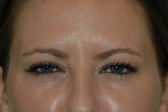 Botox injected in between the eyebrows and into the forehead after 577107
