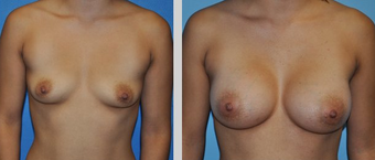 Flash Recovery Breast Augmentation TM before 253882