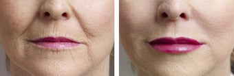 Collagen Injections before 6351