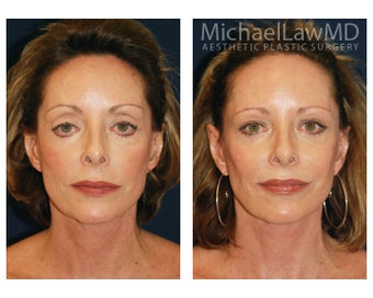 Facial Rejuvenation before 393316