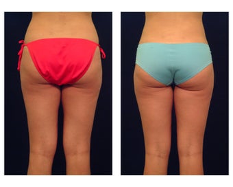Liposuction before 286670