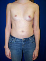 Pectus Excavatum Surgery before 121796
