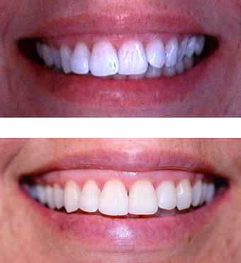 Invisalign before 109493
