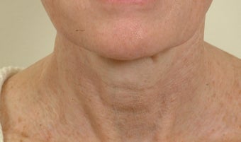 Pearl Laser Treatment after 102784