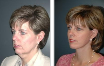 Facelift before 144308