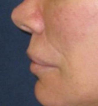 Lip lift 519741