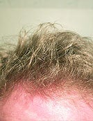 Repair by FUE – SFET Using Head, Nape and Beard Hair to create Hairline after 196039