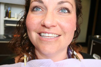 Veneers before 465803