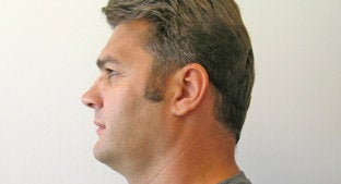 Facial Implant 494443