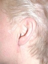 Earlobe Repair Surgery after 612309
