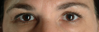Botox before 100336