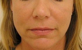 Juvederm after 314274