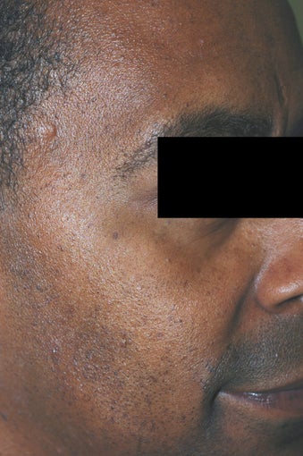 Los Angeles Mole Removal - Dermatosis Papulosa Nigra after 542716