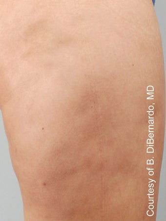 Smart Lipo after 606722