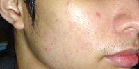 Acne Treatment with Smoothbeam before 271996
